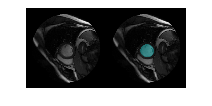 心脏左心室使用U-Net网络从Cine-MRI分割图像